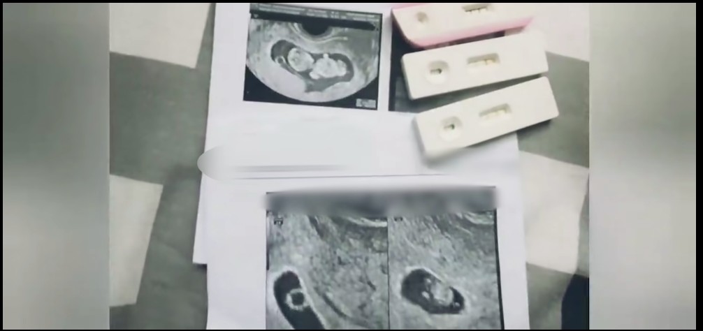 Winwyn Marquez sonogram