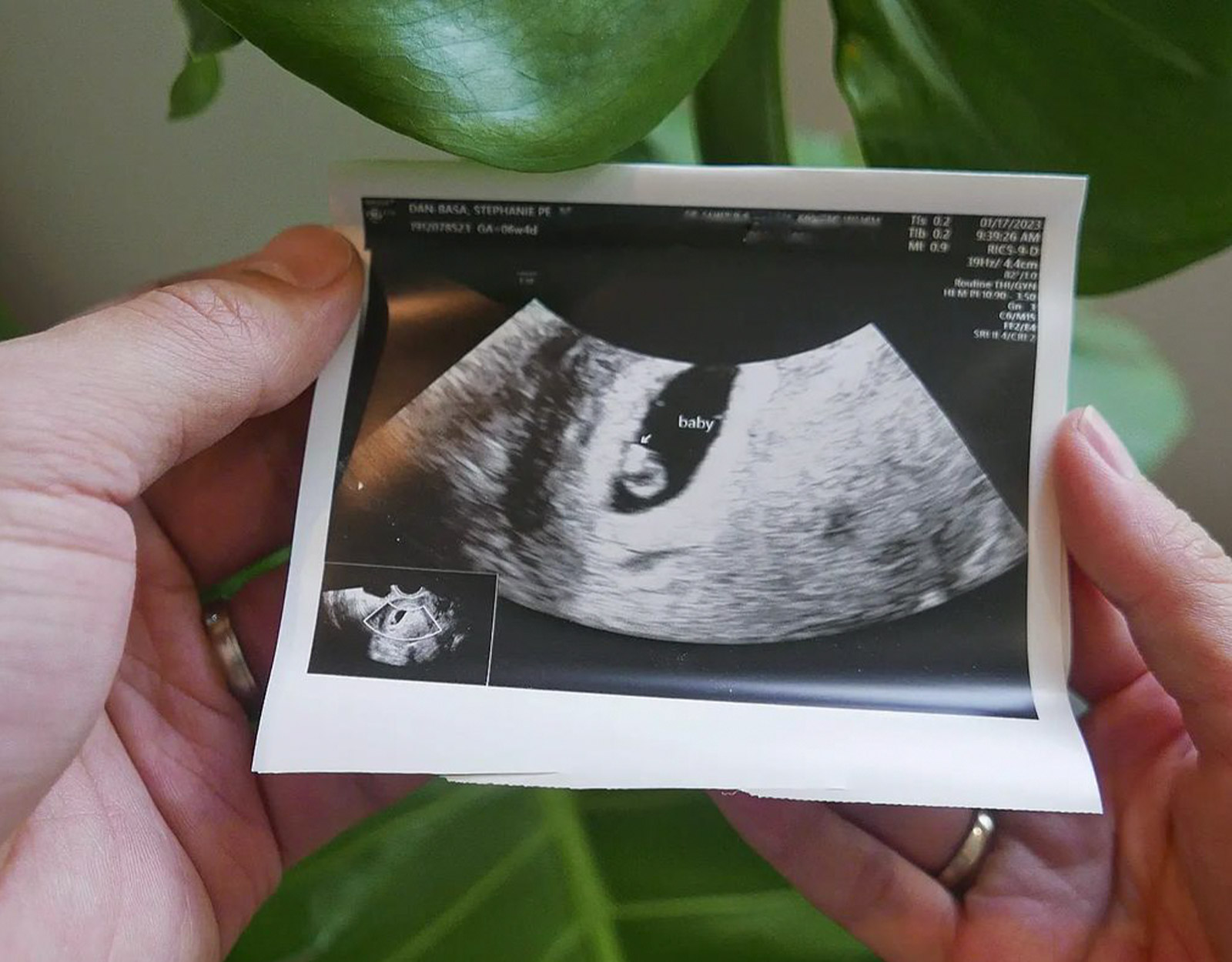 A sonogram of Victor Basa's baby
