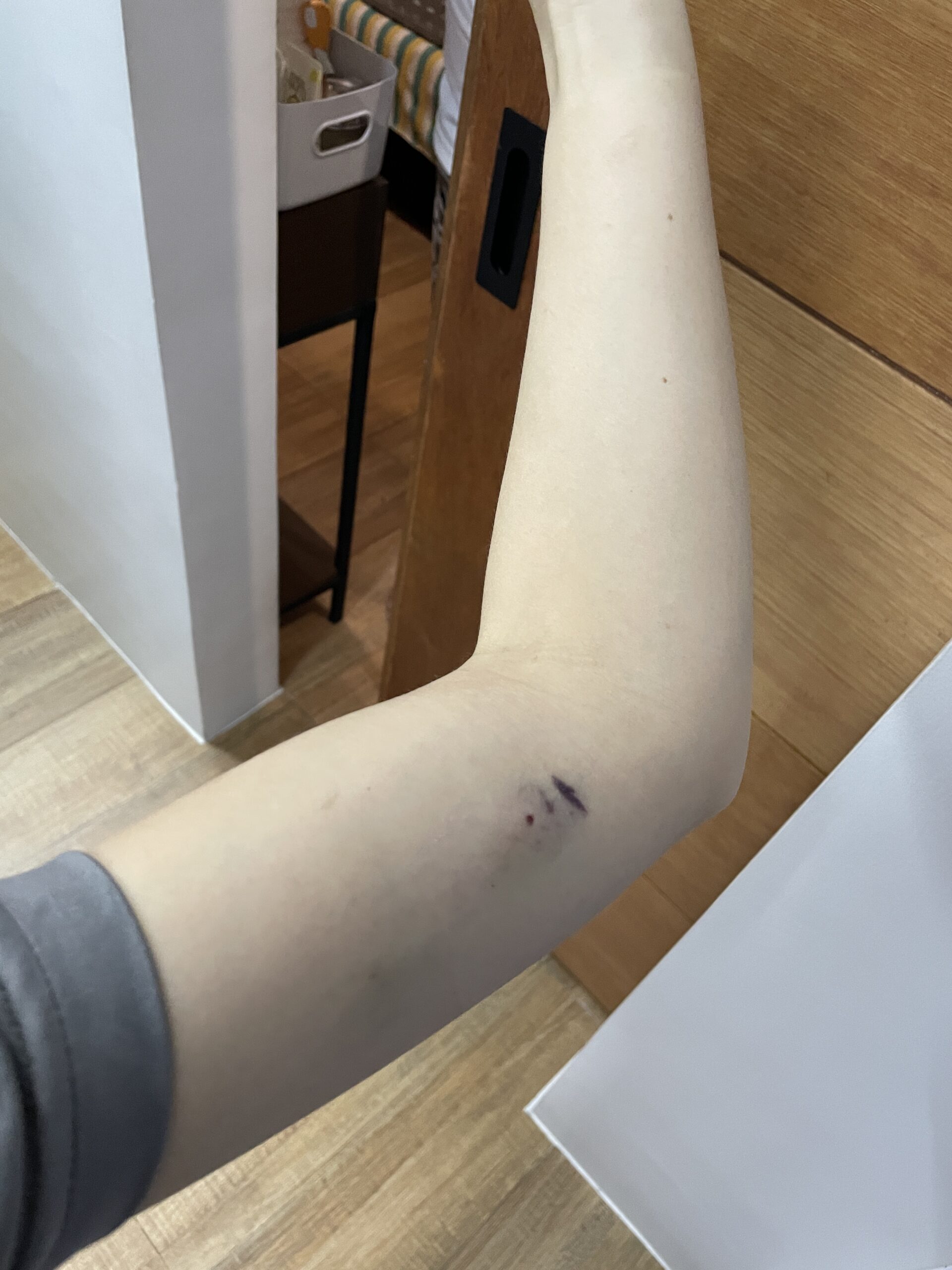 Contraceptive implant bruising