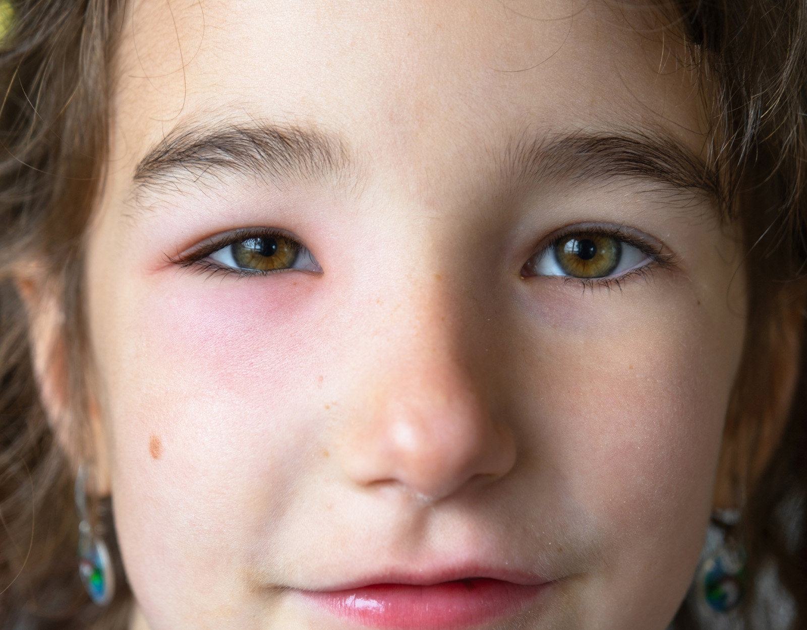 How to Treat Your Kid's Stye